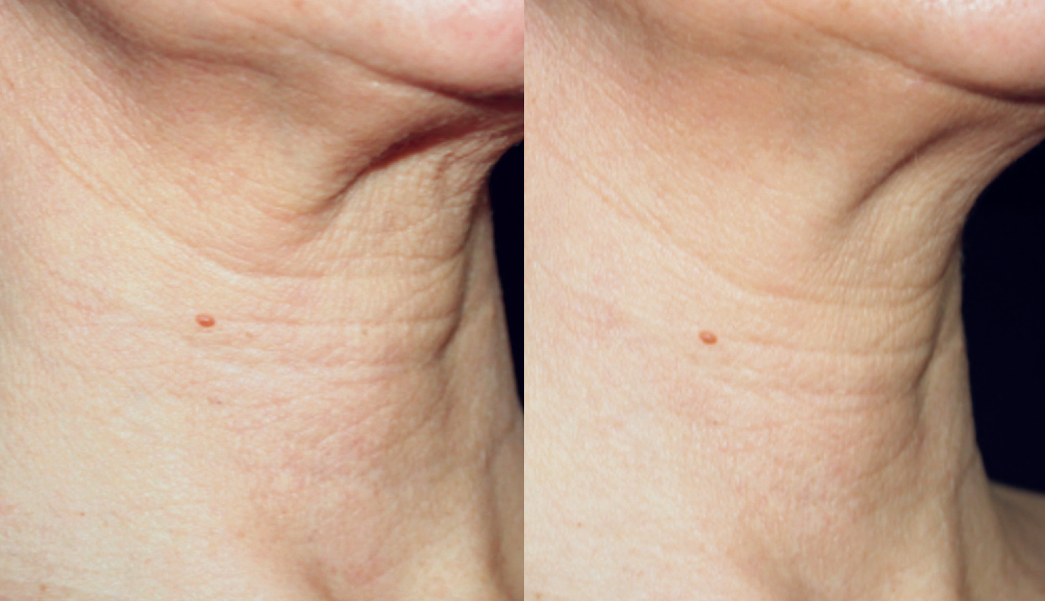 BA NECK 01