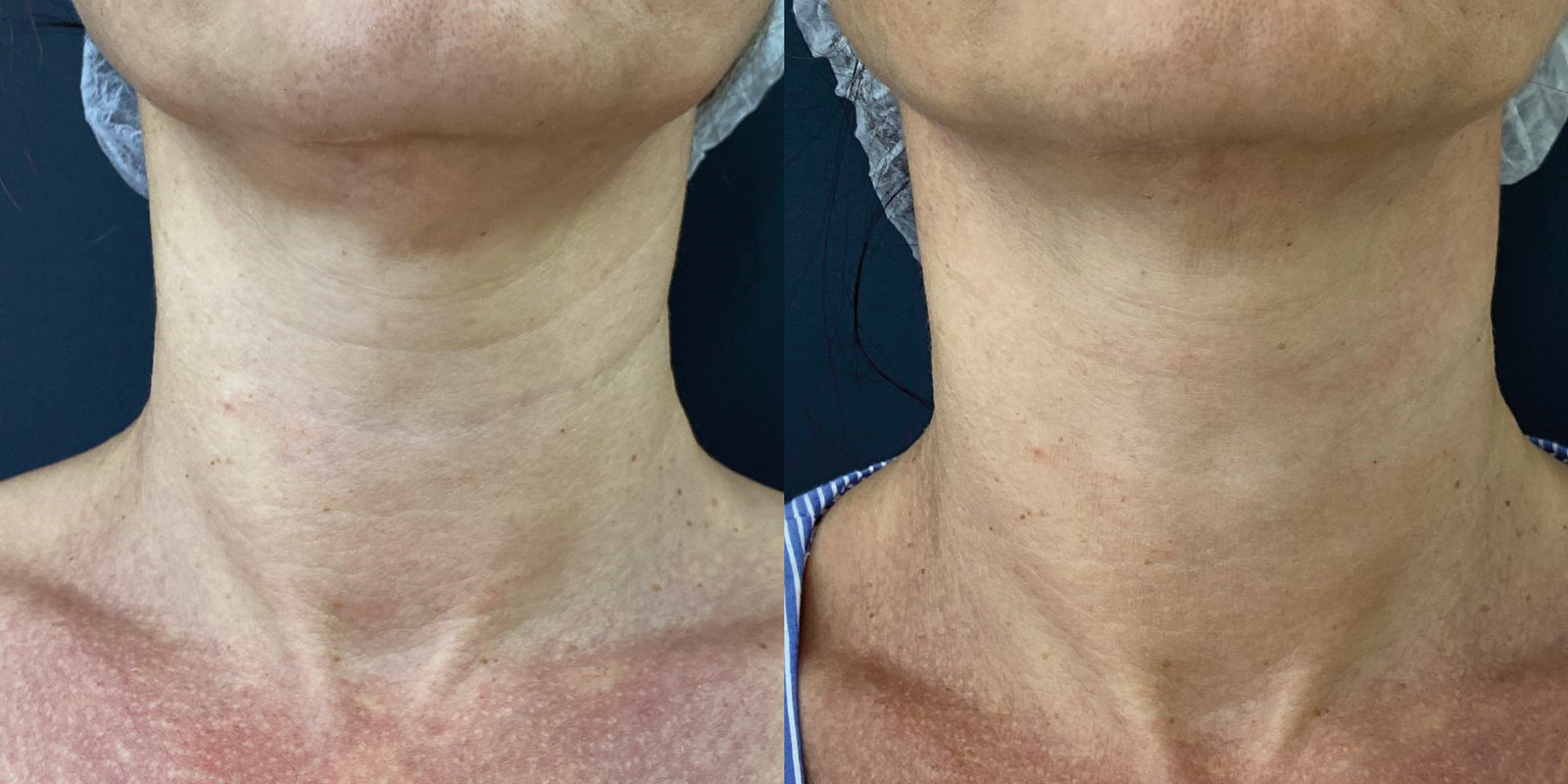 BA NECK 02