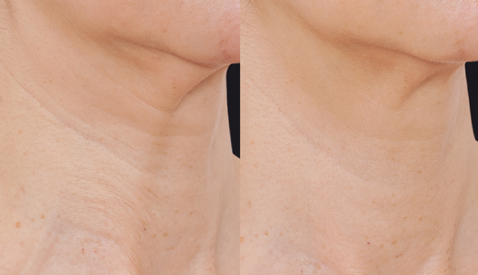 BA NECK 03