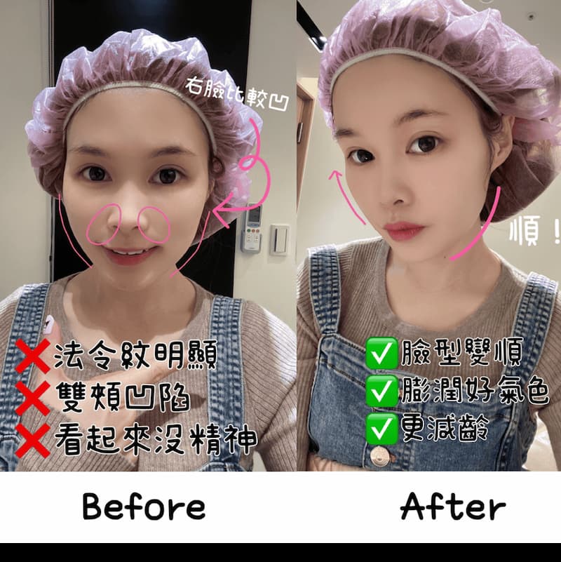 女神玻尿酸